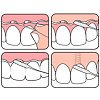 TePe Bridge and Implant floss Межзубная нить для мостов и имплантов 1 шт