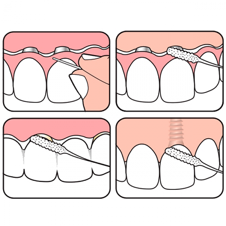 TePe Bridge and Implant floss Межзубная нить для мостов и имплантов 1 шт