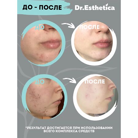 Dr. Esthetica\Др.Эстетика Крем для лица от прыщей уход за проблемной кожей 50 мл 1 шт